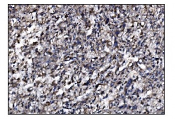 IHC staining of FFPE human liver cancer tissue with SLFN11 antibody. HIER: boil tissue sections in pH8 EDTA for 20 min and allow to cool before testing.