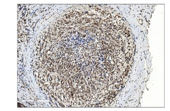 IHC staining of FFPE human gallbladder adenocarcinoma tissue with SUMO2/3 antibody. HIER: boil tissue sections in pH8 EDTA for 20 min and allow to cool before testing.