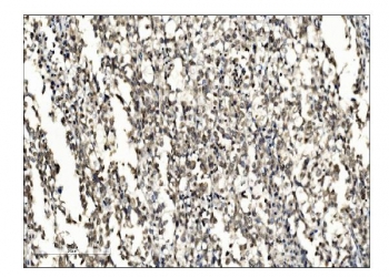 IHC staining of FFPE human bladder cancer tissue with SUMO2/3 antibody. HIER: boil tissue sections in pH8 EDTA for 20 min and allow to cool before testing.