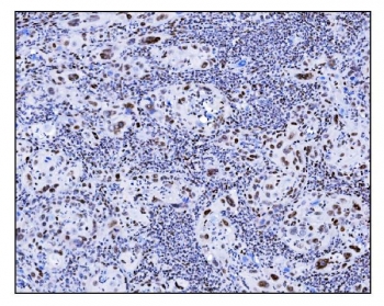 IHC staining of FFPE human gallbladder adenocarcinoma tissue with SRF antibody. HIER: boil tissue sections in pH8 EDTA for 20 min and allow to cool before testing.