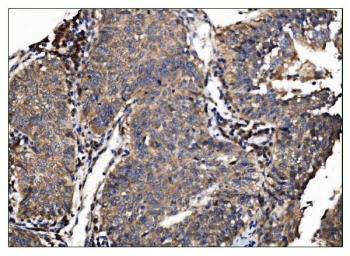 IHC staining of FFPE human lung cancer tissue with TBC1D4 antibody. HIER: boil tissue sections in pH8 EDTA for 20 min and allow to cool before testing.