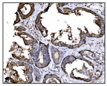 HSP90AA1 Antibody Colon Cancer IHC. Immunohistochemistry staining of FFPE human colon cancer tissue using HSP90AA1 Antibody / Molecular Chaperone Antibody demonstrates strong cytoplasmic HRP-DAB brown staining within malignant gland-forming epithelial cells. The staining pattern is consistent with expression of HSP90AA1 (HSP90a), a highly conserved ATP-dependent molecular chaperone that regulates protein folding, stabilization of client proteins, signal transduction, and cellular stress-response pathways. HSP90AA1 supports the function of numerous signaling molecules involved in cellular growth, survival, and tumor progression, making it an important target in cancer biology and proteostasis research. HIER was performed by boiling tissue sections in pH 8 EDTA buffer for 20 minutes followed by cooling prior to immunostaining.