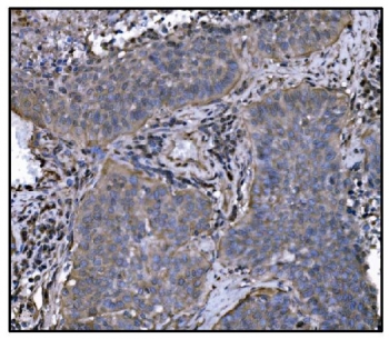 HSP90AA1 Antibody Lung Cancer IHC. Immunohistochemistry staining of FFPE human lung cancer tissue using HSP90AA1 Antibody / Molecular Chaperone Antibody demonstrates moderate cytoplasmic HRP-DAB brown staining within malignant epithelial tumor cells. The staining pattern is consistent with expression of HSP90AA1 (HSP90a), a highly conserved ATP-dependent molecular chaperone that regulates protein folding, stabilization of client proteins, signal transduction, and cellular stress-response pathways. HSP90AA1 supports the activity of numerous regulatory proteins involved in cellular proliferation, survival, and adaptation to tumor-associated stress, making it an important target in cancer biology and proteostasis research. HIER was performed by boiling tissue sections in pH 8 EDTA buffer for 20 minutes followed by cooling prior to immunostaining.