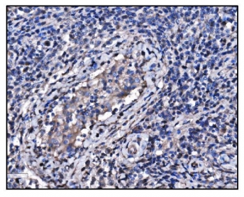HSP90AA1 Antibody Testis Cancer IHC. Immunohistochemistry staining of FFPE human testis cancer tissue using HSP90AA1 Antibody / Molecular Chaperone Antibody demonstrates cytoplasmic HRP-DAB brown staining within malignant tumor cells. The staining pattern is consistent with expression of HSP90AA1 (HSP90a), a highly conserved ATP-dependent molecular chaperone that regulates protein folding, stabilization of client proteins, signal transduction, and cellular stress-response pathways. HSP90AA1 supports the activity of numerous proteins involved in cellular proliferation, survival, and adaptation to physiological stress, making it an important target in cancer biology, proteostasis research, and studies of tumor-associated signaling networks. HIER was performed by boiling tissue sections in pH 8 EDTA buffer for 20 minutes followed by cooling prior to immunostaining.