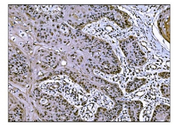 IHC staining of FFPE human esophageal squamous carcinoma tissue with COPS5 antibody. HIER: boil tissue sections in pH8 EDTA for 20 min and allow to cool before testing.
