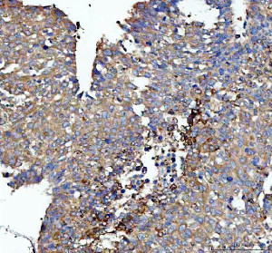 AP2A1 Antibody Human Liver Cancer IHC. Immunohistochemistry staining of FFPE human liver cancer tissue with AP2A1 Antibody at 2 ug/ml. HIER was performed using pH 8 EDTA buffer, followed by blocking with 10% goat serum. The tissue section was incubated with rabbit anti-AP2A1 antibody overnight at 4Â°C, followed by HRP-conjugated goat anti-rabbit IgG secondary antibody and DAB chromogen detection. AP2A1 Antibody / Clathrin Adaptor Protein Antibody, validated using AP2A1 knockout cells, demonstrates cytoplasmic staining and supports studies of clathrin-mediated endocytosis, vesicle trafficking and receptor internalization pathways.