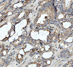AP2A1 Antibody Human Prostate Cancer IHC. Immunohistochemistry staining of FFPE human prostatic acinar adenocarcinoma tissue with AP2A1 Antibody at 2 ug/ml. HIER was performed using pH 8 EDTA buffer, followed by blocking with 10% goat serum. The tissue section was incubated with rabbit anti-AP2A1 antibody overnight at 4Â°C, followed by HRP-conjugated goat anti-rabbit IgG secondary antibody and DAB chromogen detection. AP2A1 Antibody / Clathrin Adaptor Protein Antibody, validated using AP2A1 knockout cells, demonstrates cytoplasmic staining in prostate cancer cells and supports studies of clathrin-mediated endocytosis, vesicle trafficking and receptor internalization pathways.