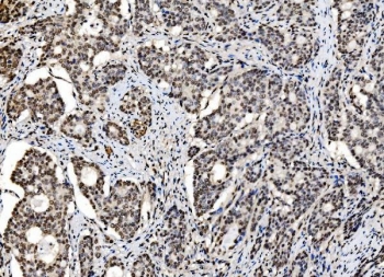 IHC staining of FFPE human gall bladder adenosquamous carcinoma tissue with CCAR2 antibody. HIER: boil tissue sections in pH8 EDTA for 20 min and allow to cool before testing.