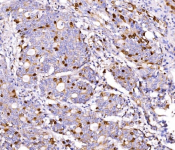 IHC staining of FFPE human gall bladder adenosquamous carcinoma tissue with Geminin antibody. HIER: boil tissue sections in pH8 EDTA for 20 min and allow to cool before testing.