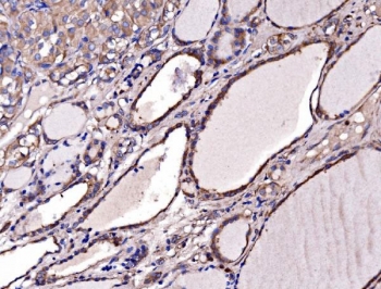 Gephyrin Antibody Papillary Thyroid Carcinoma IHC. Immunohistochemistry of FFPE human papillary thyroid carcinoma tissue using Gephyrin antibody shows HRP-DAB brown cytoplasmic and membranous staining in tumor epithelial cells, consistent with Gephyrin expression in receptor clustering and synaptic scaffold-associated signaling structures, while surrounding stromal elements display lower background. HIER: boil tissue sections in pH8 EDTA for 20 min and allow to cool before testing.