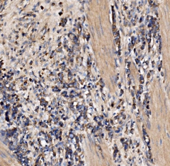 Gephyrin Antibody Stomach Cancer IHC. Immunohistochemistry of FFPE human stomach carcinoma tissue using Gephyrin antibody shows granular HRP-DAB brown cytoplasmic staining in tumor cells, consistent with Gephyrin-associated receptor clustering and inhibitory signaling scaffold localization, while surrounding stromal regions display lower background. HIER: boil tissue sections in pH8 EDTA for 20 min and allow to cool before testing.