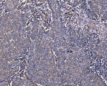 IHC staining of FFPE human lung cancer tissue with Integrin Linked Kinase antibody. HIER: boil tissue sections in pH8 EDTA for 20 min and allow to cool before testing.