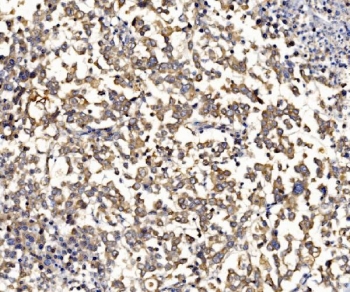 IHC staining of FFPE human pancreatic cancer tissue with RPL8 antibody. HIER: boil tissue sections in pH8 EDTA for 20 min and allow to cool before testing.