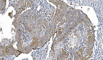 IHC staining of FFPE human lung cancer tissue with Cytochrome P450 Reductase antibody. HIER: boil tissue sections in pH8 EDTA for 20 min and allow to cool before testing.
