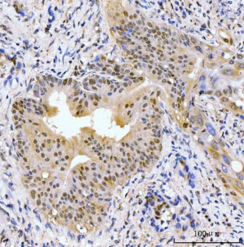 IHC staining of FFPE human gall bladder adenosquamous carcinoma tissue with AKAP 95 antibody. HIER: boil tissue sections in pH8 EDTA for 20 min and allow to cool before testing.