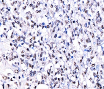 IHC staining of FFPE human lymphoma tissue with CRTC3 antibody. HIER: boil tissue sections in pH8 EDTA for 20 min and allow to cool before testing.