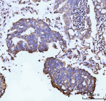 Immunohistochemistry of GLUL Antibody Rabbit Polyclonal in human gastric adenocarcinoma tissue. Formalin-fixed, paraffin-embedded human gastric adenocarcinoma sections demonstrate cytoplasmic HRP-DAB brown staining in malignant gland-forming epithelial cells consistent with Glutamate-ammonia ligase (Glutamine synthetase) expression. Tumor epithelial cells show moderate to strong cytoplasmic staining, while surrounding stromal cells display comparatively weaker signal. Heat-induced epitope retrieval was performed by boiling tissue sections in pH 8 EDTA for 20 min followed by cooling prior to antibody incubation.