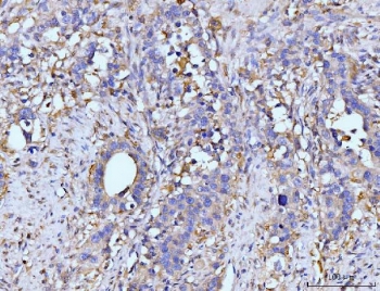 IHC staining of FFPE human appendiceal adenocarcinoma tissue with the rabbit polyclonal GLUL antibody. HIER: boil tissue sections in pH8 EDTA for 20 min and allow to cool before testing.