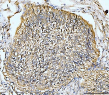 HMGCS1 Antibody Human Lung Cancer IHC. Immunohistochemical staining of FFPE human lung cancer tissue using HMGCS1 Antibody / Mevalonate Pathway Enzyme Antibody demonstrates strong cytoplasmic and membranous HRP-DAB brown staining throughout malignant tumor cells. The staining pattern is consistent with expression of HMGCS1, a key enzyme of the mevalonate pathway that catalyzes an early step in cholesterol and isoprenoid biosynthesis. Robust HMGCS1 immunoreactivity within the neoplastic cell population supports the importance of metabolic reprogramming and lipid biosynthetic pathways in lung cancer biology. The observed expression pattern is consistent with the elevated metabolic demands associated with tumor growth, membrane synthesis, and cellular proliferation. HIER: boil tissue sections in pH8 EDTA for 20 min and allow to cool before testing.