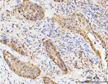 HMGCS1 Antibody Human Gallbladder Adenosquamous Carcinoma IHC. Immunohistochemical staining of FFPE human gallbladder adenosquamous carcinoma tissue using HMGCS1 Antibody / Mevalonate Pathway Enzyme Antibody demonstrates moderate to strong cytoplasmic and membranous HRP-DAB brown staining within malignant epithelial tumor cells. The staining pattern is consistent with expression of HMGCS1, a key metabolic enzyme that catalyzes an early step in the mevalonate pathway responsible for cholesterol and isoprenoid biosynthesis. Positive immunoreactivity within neoplastic cells highlights the importance of lipid metabolic pathways in supporting membrane synthesis, cellular growth, and tumor progression. The observed expression pattern supports the utility of HMGCS1 as a marker for studies of metabolic reprogramming and mevalonate pathway activity in cancer. HIER: boil tissue sections in pH8 EDTA for 20 min and allow to cool before testing.