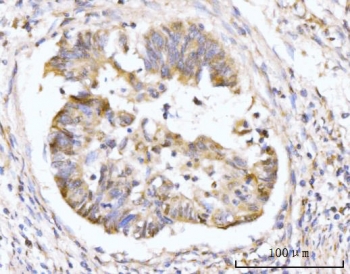 HMGCS1 Antibody Human Gastric Adenocarcinoma IHC. Immunohistochemical staining of FFPE human gastric adenocarcinoma tissue using HMGCS1 Antibody / Mevalonate Pathway Enzyme Antibody demonstrates moderate to strong cytoplasmic and membranous HRP-DAB brown staining within malignant gland-forming epithelial cells. The staining pattern is consistent with expression of HMGCS1, a key enzyme of the mevalonate pathway that catalyzes an early step in cholesterol and isoprenoid biosynthesis. Positive immunoreactivity within neoplastic gastric epithelial cells supports the importance of lipid metabolic pathways in tumor growth, membrane production, and cellular proliferation. The observed expression pattern highlights the utility of HMGCS1 as a marker for studies of metabolic reprogramming and cholesterol biosynthesis in gastric cancer. HIER: boil tissue sections in pH8 EDTA for 20 min and allow to cool before testing.