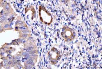 HMGCS1 Antibody Gastric Adenocarcinoma Tissue IHC. Immunohistochemical staining of FFPE human gastric adenocarcinoma tissue using HMGCS1 Antibody / Mevalonate Pathway Enzyme Antibody demonstrates distinct cytoplasmic and membranous HRP-DAB brown staining within malignant glandular epithelial cells. The staining pattern is consistent with expression of HMGCS1, a key enzyme of the mevalonate pathway responsible for the synthesis of HMG-CoA, an essential precursor for cholesterol and isoprenoid biosynthesis. Positive immunoreactivity within neoplastic gastric glands highlights the importance of metabolic pathways that support membrane biogenesis, cellular proliferation, and tumor growth. These results support the utility of HMGCS1 as a marker for studies of cholesterol metabolism and metabolic reprogramming in gastric adenocarcinoma. HIER: boil tissue sections in pH8 EDTA for 20 min and allow to cool before testing.