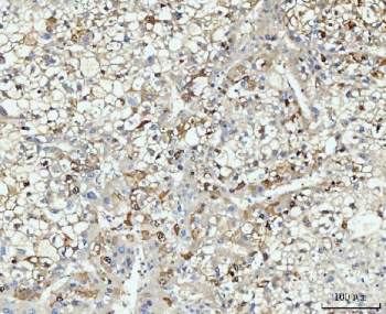 HMGCS1 Antibody Human Liver Cancer IHC. Immunohistochemical staining of FFPE human liver cancer tissue using HMGCS1 Antibody / Mevalonate Pathway Enzyme Antibody demonstrates widespread cytoplasmic and membranous HRP-DAB brown staining throughout malignant hepatocyte-like tumor cells. The staining pattern is consistent with expression of HMGCS1, a key enzyme that catalyzes an early step in the mevalonate pathway and supports cholesterol and isoprenoid biosynthesis. Strong HMGCS1 immunoreactivity within the neoplastic cell population highlights the importance of lipid metabolism and metabolic reprogramming in liver cancer biology. The observed expression pattern supports the utility of HMGCS1 as a marker for studies of cholesterol biosynthesis, cellular proliferation, and mevalonate pathway activity in hepatic malignancies. HIER: boil tissue sections in pH8 EDTA for 20 min and allow to cool before testing.