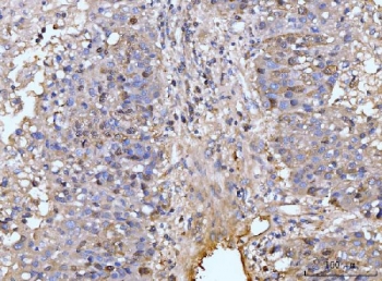 HMGCS1 Antibody Hepatocellular Carcinoma IHC. Immunohistochemical staining of FFPE human liver cancer tissue using HMGCS1 Antibody / Mevalonate Pathway Enzyme Antibody demonstrates moderate cytoplasmic and membranous HRP-DAB brown staining within malignant hepatocyte-like tumor cells. The staining pattern is consistent with expression of HMGCS1, a key enzyme of the mevalonate pathway responsible for the synthesis of HMG-CoA, an essential precursor for cholesterol and isoprenoid biosynthesis. Positive immunoreactivity is observed throughout neoplastic cell populations and supports the role of HMGCS1 in metabolic pathways that contribute to membrane synthesis, cellular growth, and tumor progression. These results demonstrate the utility of HMGCS1 as a marker for studies of cholesterol metabolism and metabolic reprogramming in hepatocellular malignancies. HIER: boil tissue sections in pH8 EDTA for 20 min and allow to cool before testing.