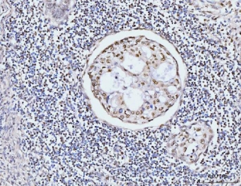 IHC staining of FFPE human gastric adenocarcinoma tissue with KIFC1 antibody. HIER: boil tissue sections in pH8 EDTA for 20 min and allow to cool before testing.