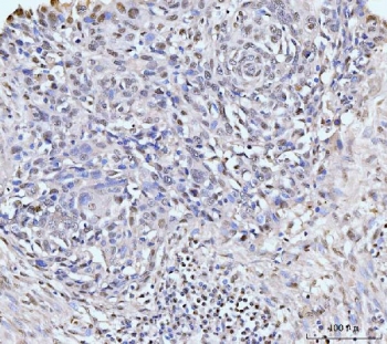 IHC staining of FFPE human esophageal squamous carcinoma tissue with KIFC1 antibody. HIER: boil tissue sections in pH8 EDTA for 20 min and allow to cool before testing.
