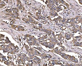 IHC staining of FFPE human breast cancer tissue with LSR antibody. HIER: boil tissue sections in pH8 EDTA for 20 min and allow to cool before testing.