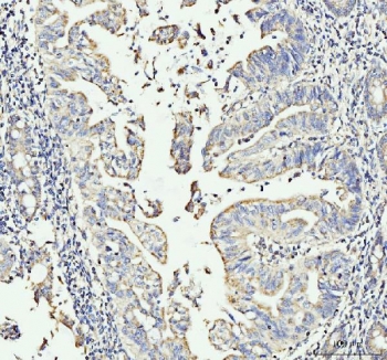 IHC staining of FFPE human gastric adenocarcinoma tissue with MOV10 antibody. HIER: boil tissue sections in pH8 EDTA for 20 min and allow to cool before testing.