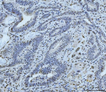 IHC staining of FFPE human gall bladder adenosquamous carcinoma tissue with Meiotic recombination 11 antibody. HIER: boil tissue sections in pH8 EDTA for 20 min and allow to cool before testing.