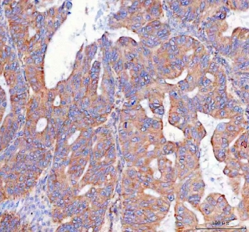IHC staining of FFPE human ovarian cancer tissue with Prostaglandin E synthase 2 antibody. HIER: boil tissue sections in pH8 EDTA for 20 min and allow to cool before testing.