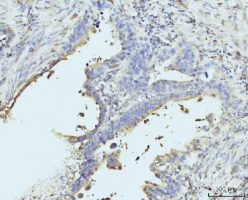 IHC staining of FFPE human appendiceal adenocarcinoma tissue with RPL23 antibody. HIER: boil tissue sections in pH8 EDTA for 20 min and allow to cool before testing.