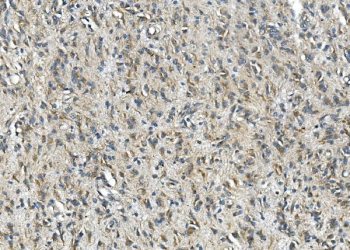 IHC staining of FFPE human glioma tissue with Synaptophysin antibody. HIER: boil tissue sections in pH8 EDTA for 20 min and allow to cool before testing.