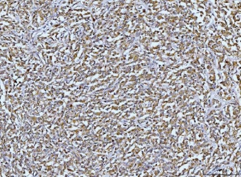 DUSP6 Antibody Human Lymphadenoma IHC. Immunohistochemical staining of FFPE human lymphadenoma tissue using DUSP6 antibody demonstrates widespread cytoplasmic HRP-DAB brown staining throughout neoplastic lymphoid cell populations. The staining pattern is consistent with expression of DUSP6, a dual-specificity phosphatase that functions as a key negative regulator of ERK/MAPK signaling pathways. By controlling the phosphorylation state of ERK proteins, DUSP6 helps modulate signaling networks involved in cellular proliferation, differentiation, survival, and responses to growth factor stimulation. The observed staining supports the role of DUSP6 in regulating intracellular signaling pathways that influence cellular homeostasis and tissue biology. HIER: boil tissue sections in pH 8 EDTA for 20 minutes and allow to cool before testing.