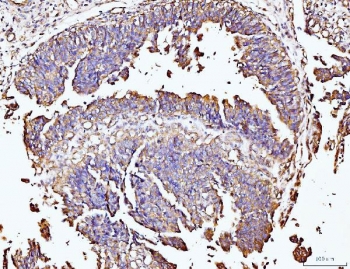 DUSP6 Antibody Human Colonic Adenocarcinoma IHC. Immunohistochemical staining of FFPE human colonic adenocarcinoma tissue using DUSP6 antibody demonstrates moderate to strong cytoplasmic HRP-DAB brown staining within neoplastic gland-forming epithelial cells. The staining pattern is consistent with expression of DUSP6, a dual-specificity phosphatase that functions as a key negative regulator of ERK/MAPK signaling pathways. DUSP6 modulates cellular responses to growth factor stimulation by controlling ERK phosphorylation and signaling duration, thereby influencing pathways associated with cellular proliferation, differentiation, and survival. The observed staining within tumor epithelial structures supports the role of DUSP6 in regulating intracellular signaling networks that contribute to tissue homeostasis and cellular growth control. HIER: boil tissue sections in pH 8 EDTA for 20 minutes and allow to cool before testing.