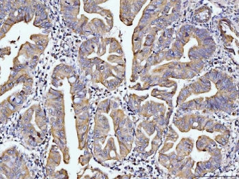 DUSP6 Antibody Human Rectal Cancer IHC. Immunohistochemical staining of FFPE human rectal cancer tissue using DUSP6 antibody demonstrates moderate cytoplasmic HRP-DAB brown staining within neoplastic glandular epithelial cells. The staining pattern is consistent with expression of DUSP6, a dual-specificity phosphatase that functions as a key negative regulator of ERK/MAPK signaling pathways. By dephosphorylating activated ERK proteins, DUSP6 helps control signaling intensity and duration, thereby influencing cellular proliferation, differentiation, survival, and responses to growth factor stimulation. The observed expression within malignant glandular structures supports the role of DUSP6 in regulating intracellular signaling networks that contribute to tissue homeostasis and cellular growth control. HIER: boil tissue sections in pH 8 EDTA for 20 minutes and allow to cool before testing.