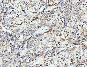 DUSP6 Antibody Human Liver Cancer IHC. Immunohistochemical staining of FFPE human liver cancer tissue using DUSP6 antibody demonstrates moderate membranous and cytoplasmic HRP-DAB brown staining within neoplastic hepatic cell populations. The staining pattern is consistent with expression of DUSP6, a dual-specificity phosphatase that functions as a key negative regulator of ERK/MAPK signaling pathways. DUSP6 modulates cellular responses to growth factor stimulation by controlling ERK phosphorylation and signaling duration, thereby influencing pathways associated with cellular proliferation, differentiation, survival, and tissue homeostasis. The observed expression within tumor cells supports the role of DUSP6 in regulating intracellular signaling networks that govern cellular growth and signal transduction. HIER: boil tissue sections in pH 8 EDTA for 20 minutes and allow to cool before testing.