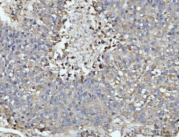 DUSP6 Antibody Human Liver Cancer Tissue IHC. Immunohistochemical staining of FFPE human liver cancer tissue using DUSP6 antibody demonstrates diffuse cytoplasmic HRP-DAB brown staining throughout neoplastic hepatic cell populations. The staining pattern is consistent with expression of DUSP6, a dual-specificity phosphatase that functions as a key negative regulator of ERK/MAPK signaling pathways. By dephosphorylating activated ERK proteins, DUSP6 helps modulate signaling intensity and duration, thereby influencing cellular proliferation, differentiation, survival, and responses to growth factor stimulation. The widespread staining observed within tumor cells supports the role of DUSP6 in maintaining signaling homeostasis within pathways that regulate cellular growth and tissue biology. HIER: boil tissue sections in pH 8 EDTA for 20 minutes and allow to cool before testing.