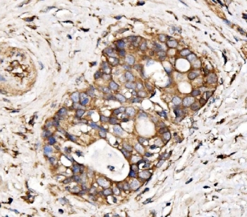 IHC staining of FFPE human bladder adenosquamous carcinoma tissue with IRBIT antibody. HIER: boil tissue sections in pH8 EDTA for 20 min and allow to cool before testing.