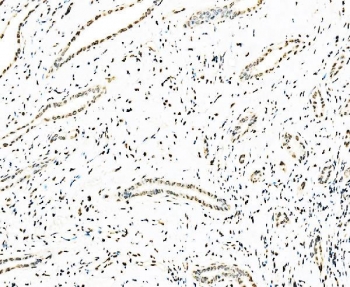IHC staining of FFPE human squamous metaplasia of the renal pelvis tissue with Splicing factor 1 antibody. HIER: boil tissue sections in pH8 EDTA for 20 min and allow to cool before testing.