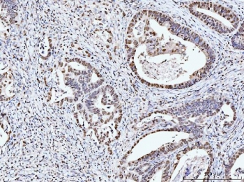 IHC staining of FFPE human rectal moderately differentiate adenocarcinoma tissue with MCM6 antibody. HIER: boil tissue sections in pH8 EDTA for 20 min and allow to cool before testing.