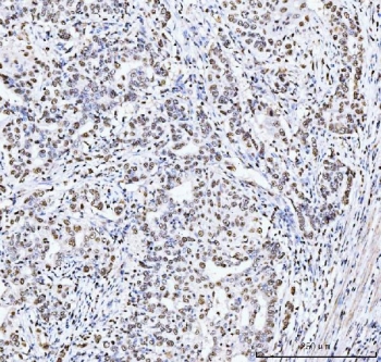 IHC staining of FFPE human metaplasia of squamous cells of the renal pelvis tissue with MCM6 antibody. HIER: boil tissue sections in pH8 EDTA for 20 min and allow to cool before testing.