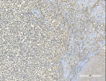 IHC staining of FFPE human testis cancer with EPRS1 antibody. HIER: boil tissue sections in pH8 EDTA for 20 min and allow to cool before testing.