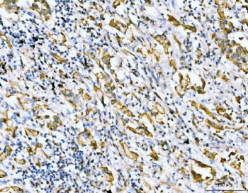 IHC staining of FFPE human lung cancer tissue with Filamin B antibody. HIER: boil tissue sections in pH8 EDTA for 20 min and allow to cool before testing.
