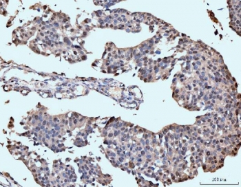 IHC staining of FFPE human bladder epithelial carcinoma tissue with Neurofibromin antibody. HIER: boil tissue sections in pH8 EDTA for 20 min and allow to cool before testing.