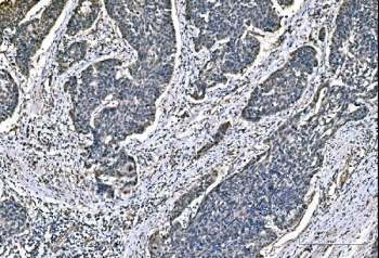 IHC staining of FFPE human bladder epithelial carcinoma tissue with Dynein light chain 1 antibody. HIER: boil tissue sections in pH8 EDTA for 20 min and allow to cool before testing.
