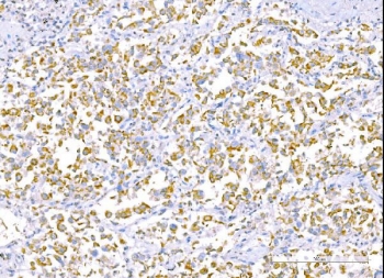 IHC staining of FFPE human lung cancer tissue with RLIP1 antibody. HIER: boil tissue sections in pH8 EDTA for 20 min and allow to cool before testing.